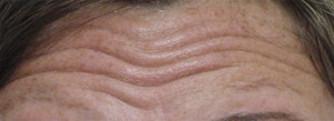 Forehead lines