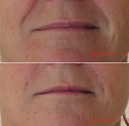 dermal filler results 3