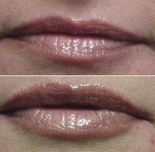 dermal filler results 2