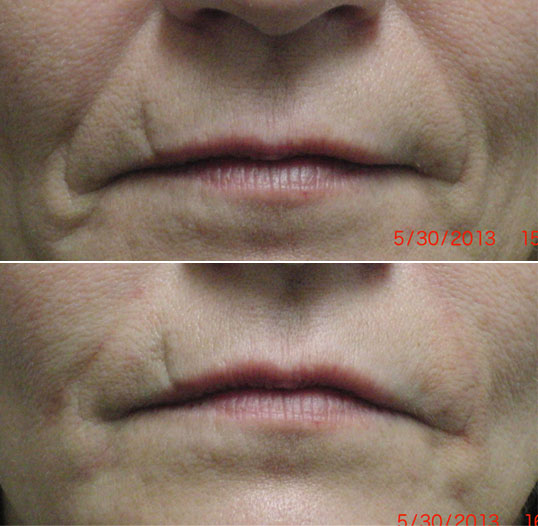 dermal filler results 5