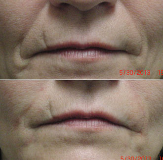 dermal filler results 6