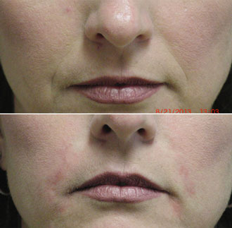 dermal filler results 7