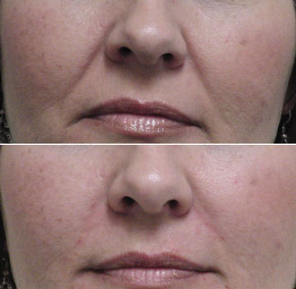 dermal filler results 8