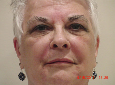 after Radiesse fillers