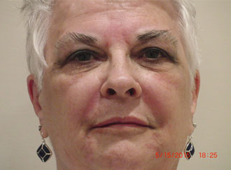 before Radiesse fillers