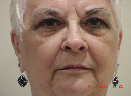 before Radiesse fillers