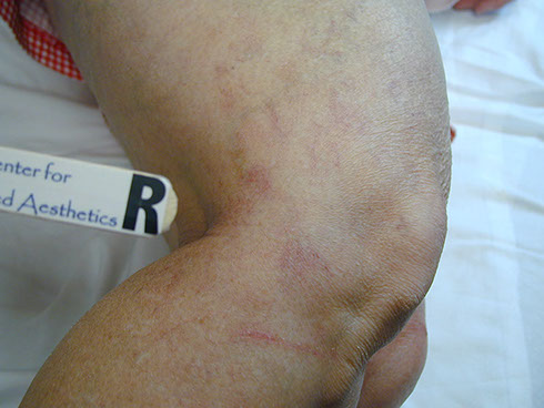 after sclerotherapy 1