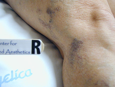 before sclerotherapy 1