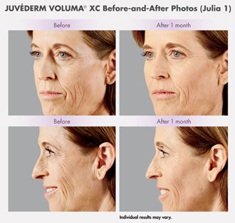 Juvederm Voluma XC before and after results